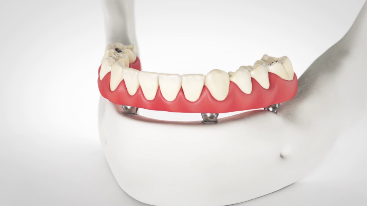 AllOn4 Dental Implant Attachment Animation YouTube