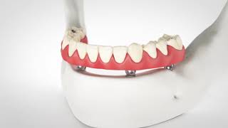 All-On-4 Dental Implant Attachment Animation