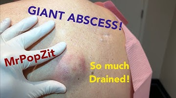 Very full abscess on back is drained with Incision & Drainage procedure. Follow up at end of video.