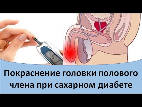 Покраснение головки полового члена при сахарном диабете