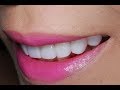 Video of Dental Veneers Procedure To a Young Patient at Cosmetic Dental Associates