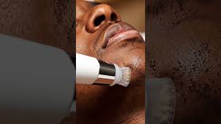 “Most Satisfying Blackhead Vacuum Extraction Ever! (Ultra Macro) 🧼✨”