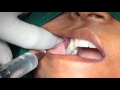 Posterior Superior Alveolar Nerve Block