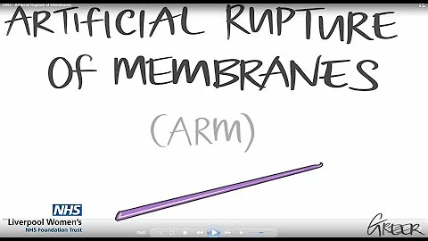 The Breaking of waters or Artificial Rupture of membranes