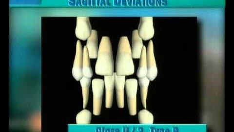 Clip 39: Frontal View of Development of Class II/2 Type B