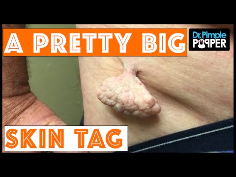 Dr Pimple Popper: A Pretty Big Skin Tag...