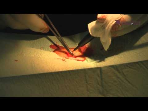 Хирургично премахване на образувание от кожата