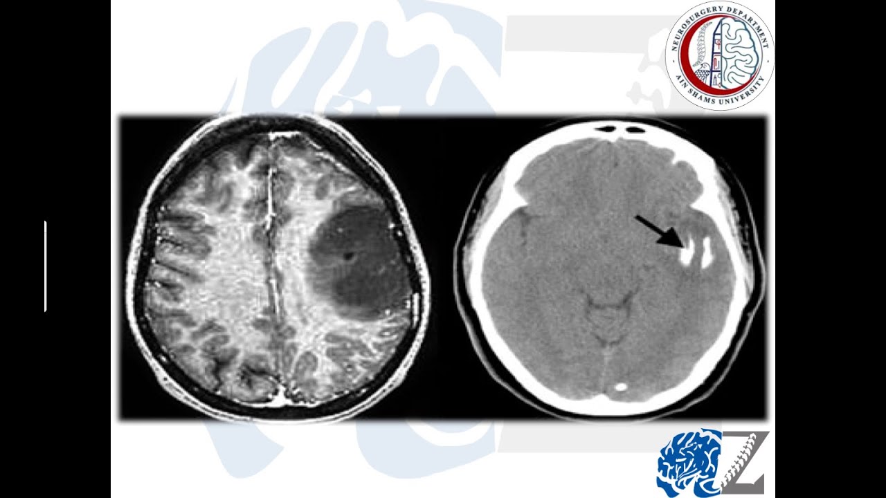 Brain Tumours (7):  Gliomas (5):  Oligodendroglioma    أورام المخ الدبقية/النجمية