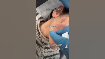 This is how we inject Sculptra 💥