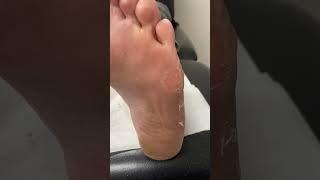 Dive Into Podiatry Wonders! Watch How An Aussie Podiatrist Tackles Corn & Callus Removal.