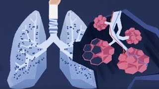 How exactly do inhalers work?