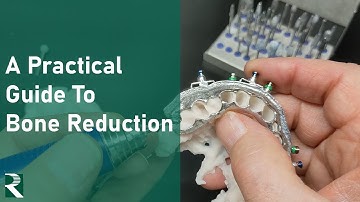 A Practical Guide to Full Arch Bone Reduction in a CHROME GuidedSMILE Natural FP1 Prosthetic Case