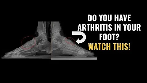 Do You Have Arthritis In The Middle Of Your Foot? ...