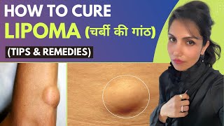 How To Cure Lipoma Naturally (चर्बी की गांठ)