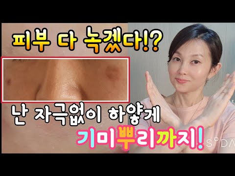 [미라클Q&A]기미☝️어드마이어!식초!셀푸드!! 모든제품 자극없이 녹이는 꿀팁!