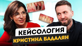 Кристина Бадалян - Рецессия десны | Пациенты с имплантатами | Кейсология | Дентал Кейсы