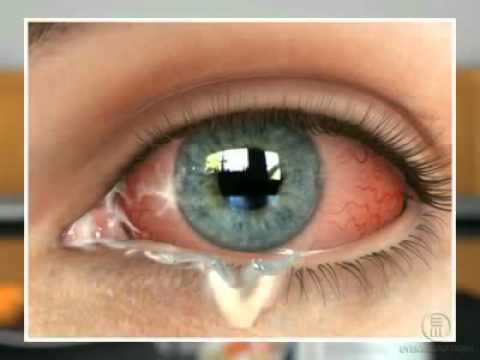 Video: Albucid-DF - Instrucțiuni De Utilizare A Picăturilor De Ochi, Preț, Recenzii