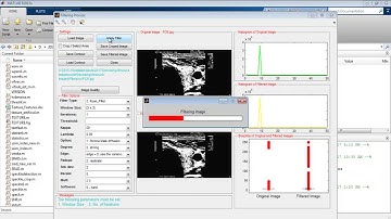 Speckle Denoising in Ultrasound Images MATLAB Projects