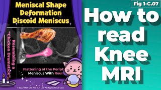 (Fig 1-C.07) Meniscal shape deformation and torn lateral discoid meniscus