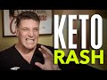 Keto Rash