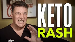 Ep:23 Keto Rash