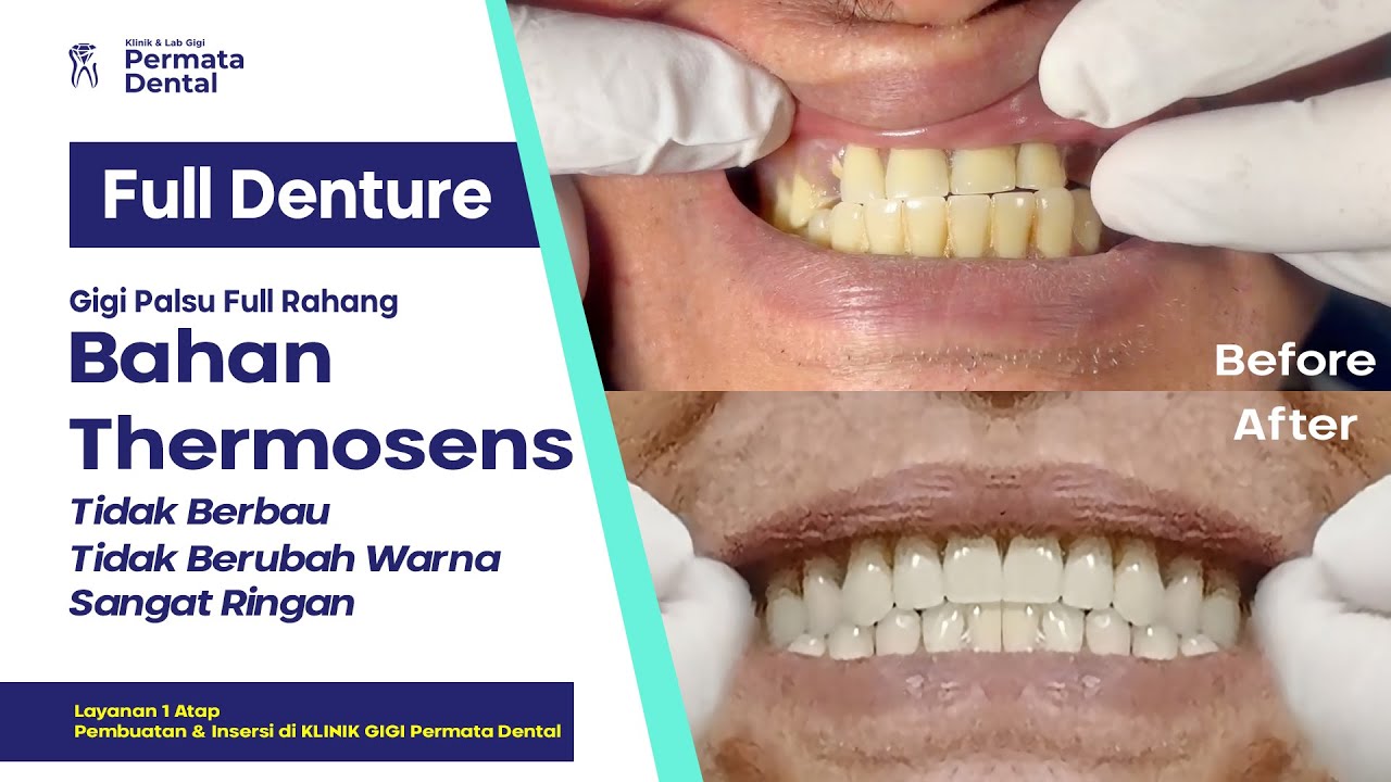 Pembuatan & Insersi Gigi Palsu Bahan Thermosens di Klinik Gigi Permata Dental Jember