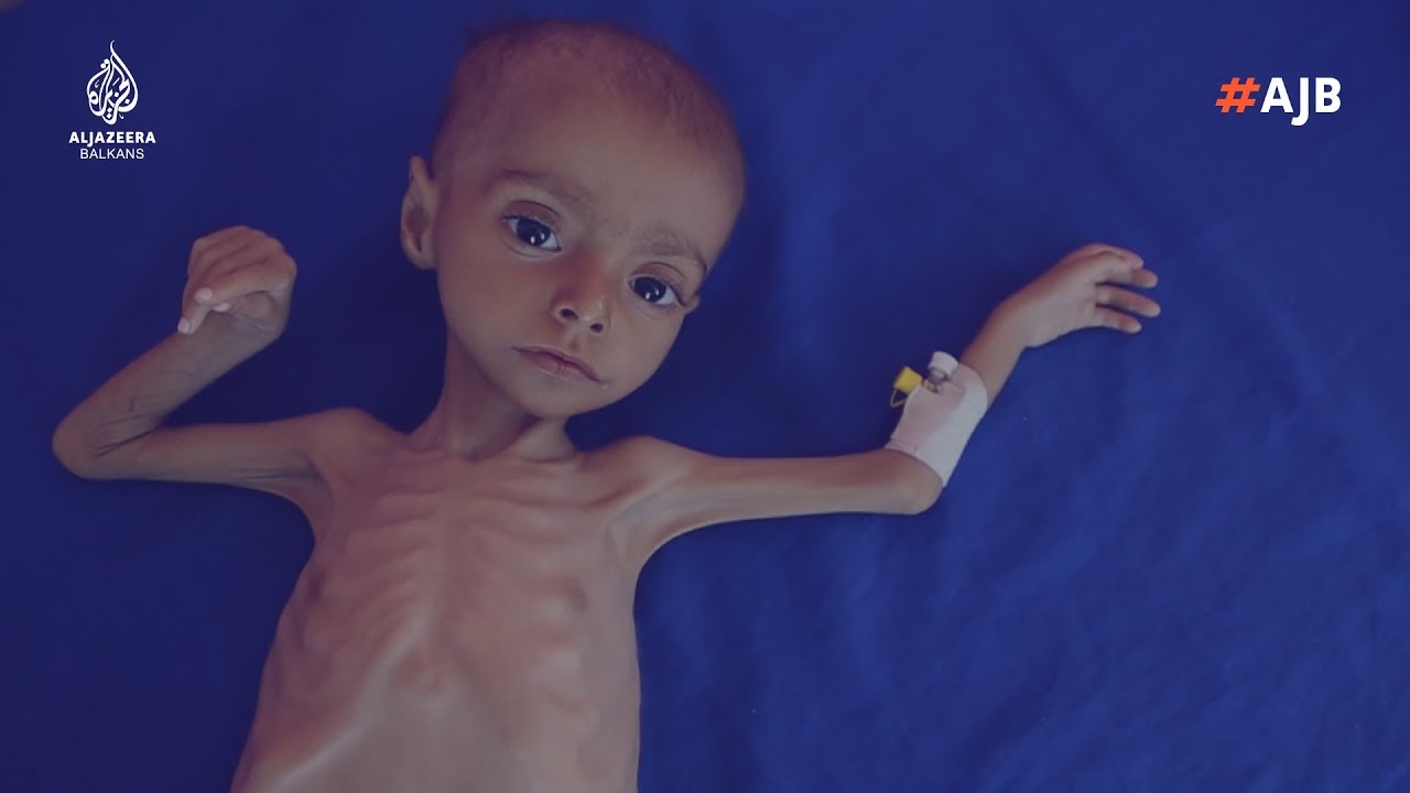 يموت الأطفال في اليمن