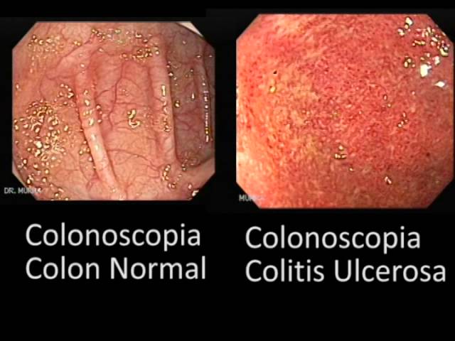 Colonoscopia De Colite Ulcerosa Enterocolitis Y Otras Manifestaciones