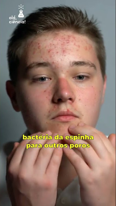 Espremer espinhas deixa a pele manchada? #Shorts
