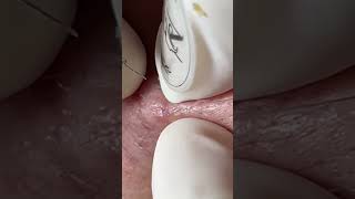 Acne Treatment Mai Ngoc