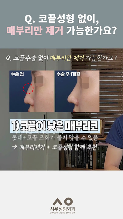 시우Tv Siwoo Plastic Surgery - Youtube