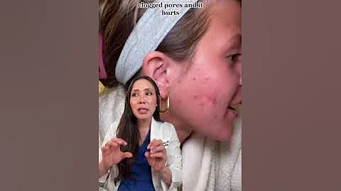 Retinol Purge Demystified: Managing Acne Breakouts During the Transition | Dr. Mamina