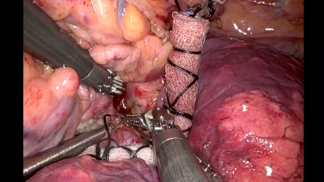 Totally Robotic Convergent (Hybrid Ablation) Procedure for Atrial Fibrillation