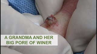 A Grandma and Her Big Pore of Winer | Dr. Derm