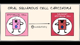 Oral squamous cell carcinoma - Etiology and Pathogenesis