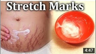 HOW TO GET RID OF STRETCH MARKS INSTANTLY  !