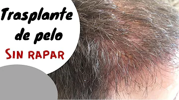 ¿Se puede afeitar el pelo trasplantado?