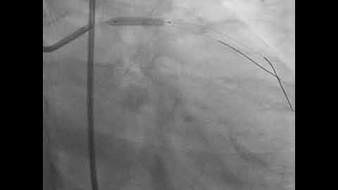 PROVISIONAL STENTING OF LAD - D1 BIFURCATION