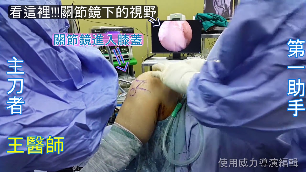 膝蓋前十字韌帶重建手術大公開 Youtube