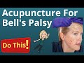 BELLS PALSY ACUPUNCTURE - know what to expect