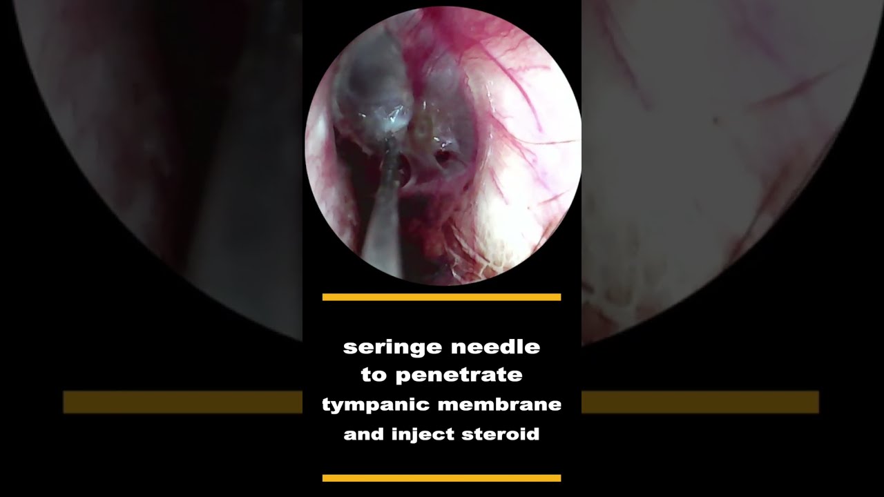 Intratympanic steroid injection