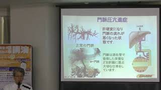 食道静脈瘤と門脈圧亢進症 2019.5.16
