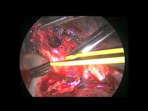 Fissure Based VATS Lobectomy : Right Upper Lobectomy