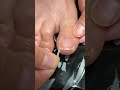 Ingrown Toenail Correction | Foot Care | Nail Treatment Shorts 👣