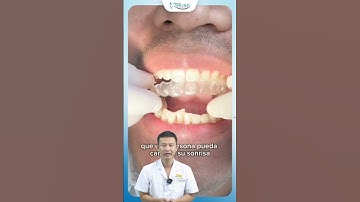 Răng Khấp Khểnh Có Niềng Được Invisalign Không ? | Bác Sĩ Yên