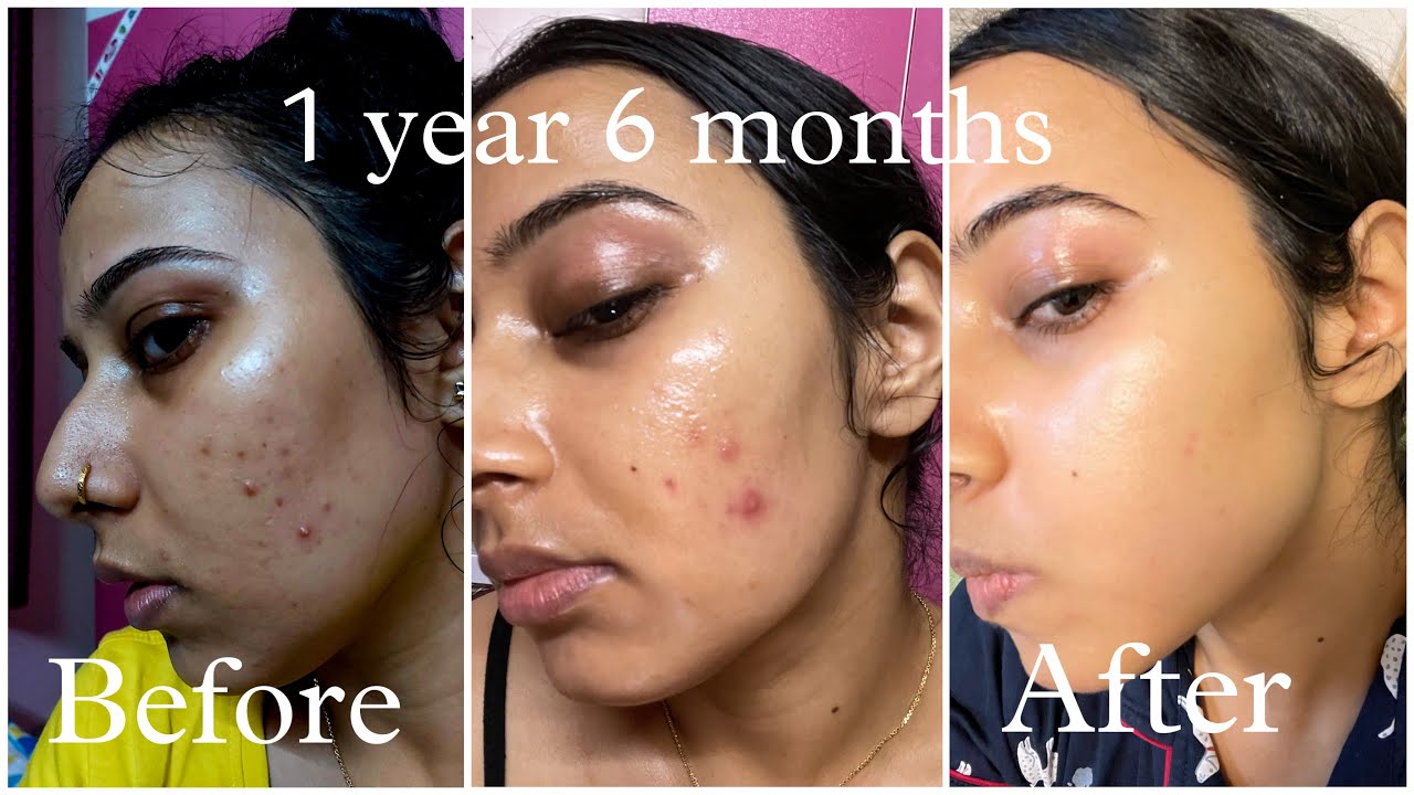 tretinoin journey