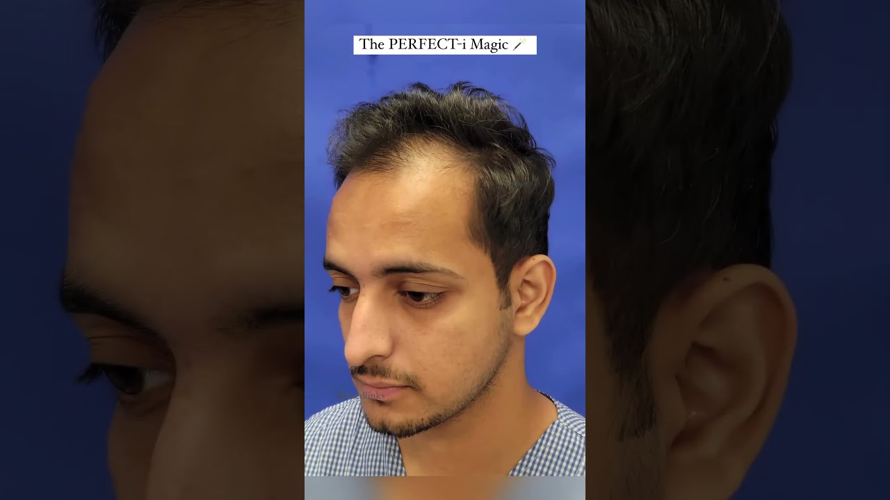  2024 Amazing Hair Transplant Results After 6 Months Shorts Shortsfeed Viral