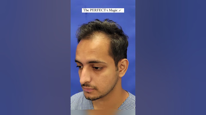 {2024) 💥Amazing Hair Transplant Results After 6 Months💥 #shorts #shortsfeed #viral