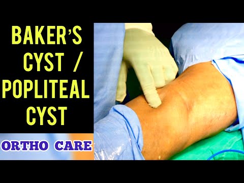 Video: Kne Cyste - Baker (becker's) Cyste, Behandling Og Kirurgi