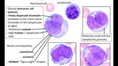 Acute promyelocytic leukemia APL ; Definition, Causes, symptoms, Diagnosis, Treatment